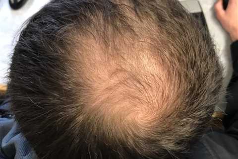 [Hair Growth] Vitamin D + Minoxidil Superior to Monotherapy
