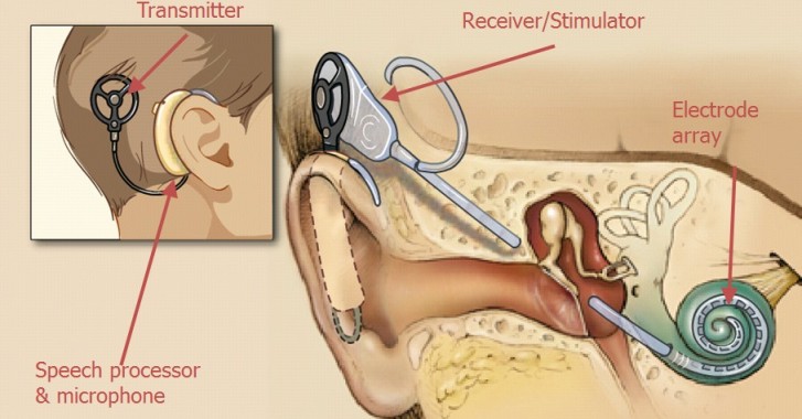 Questions You Need to Ask About Cochlear Implants