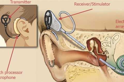 Questions You Need to Ask About Cochlear Implants