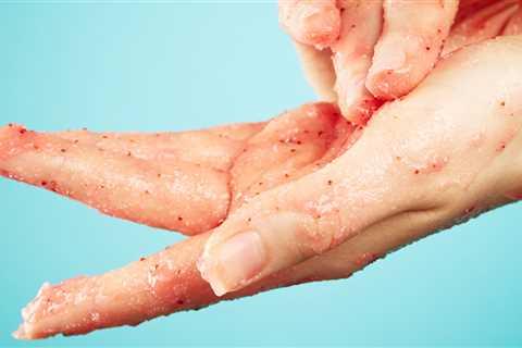 This DIY Miracle Scrub Naturally Cured One Woman's Eczema