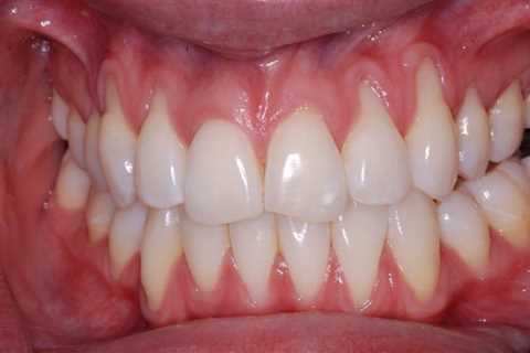 Can Gum Recession Be Reversed? – A RAY OF SUN