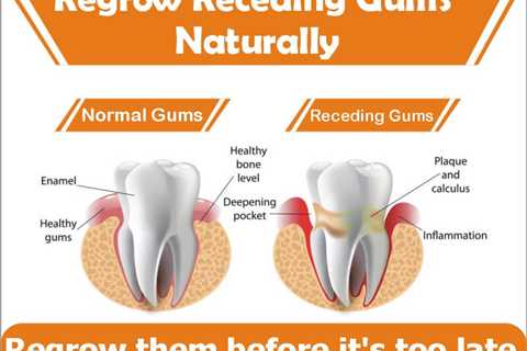 Top 5 Natural Gum Regrowth Products For Receding Gums - Sick Partner