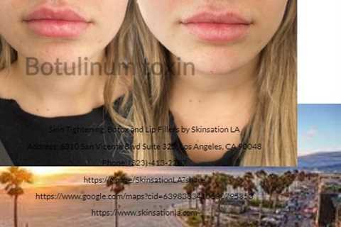 Skin Tightening, Botox and Lip Fillers by Skinsation LA