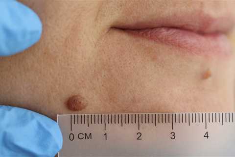 Trying to Remove That Mole At Home? Here's Why It's a Terrible Idea