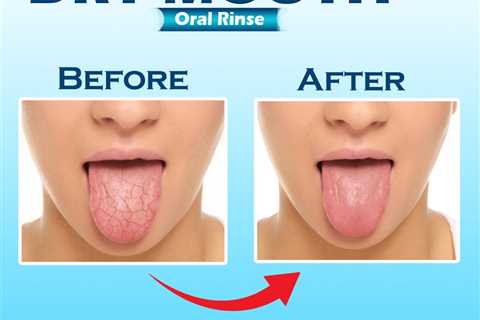 What to Use for Dry Mouth