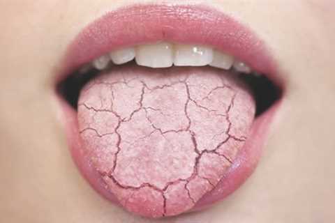 What is the best product for dry mouth