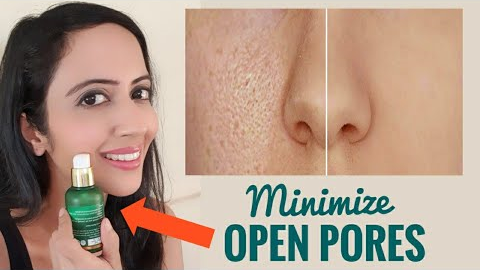 How I am treating my OPEN PORES | Enlarged Pores - Causes & Treatment