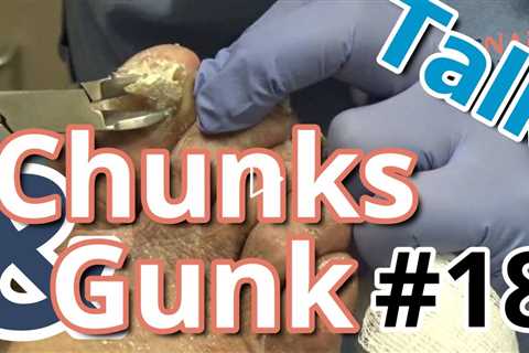 Chunks 'n Gunk #18 with Dr Nail Nipper discussion. FEET-ure Friday (2022)