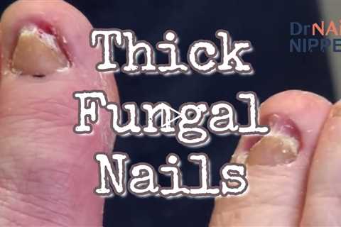 Throwback - Thick Fungal Toenails