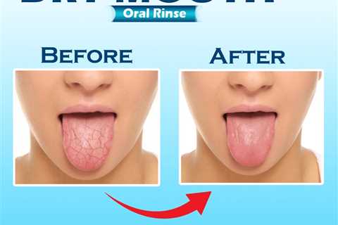 treat dry mouth and throat naturally