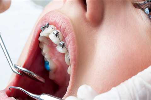 Do cosmetic braces hurt?