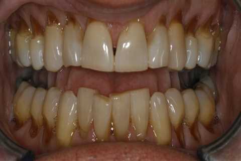 Can cosmetic dentistry fix receding gums?