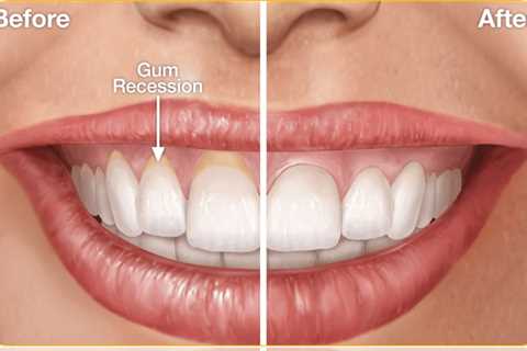Why Are My Gums Receding?