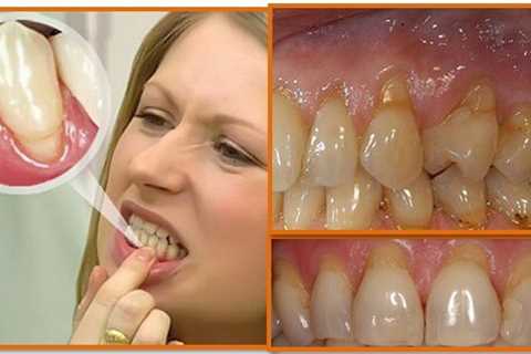 How To Stimulate Gum Regrowth
