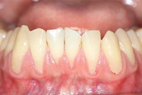 How To Grow Gums Back?