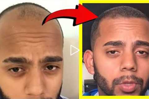 Crazy Minoxidil 5% Hair Growth in 2.5 Months Fails after 2.5 YEARS!? Here's WHY!