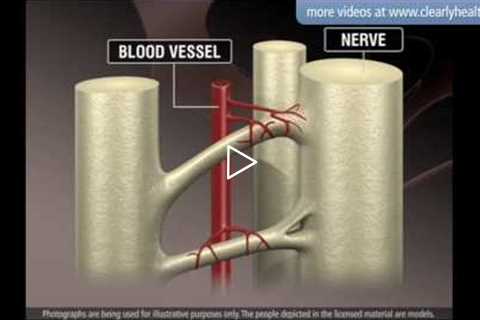 Diabetes: Nerve damage (Neuropathy)