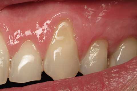 How Do You Stop Receding Gums?