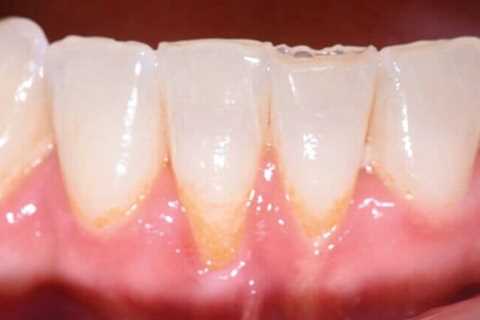 What Can You Do To Reverse Receding Gums?