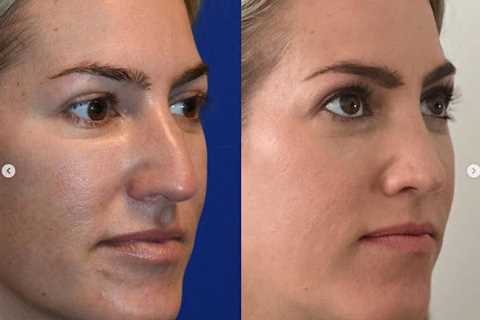 The Portland Center for Facial Plastic Surgery : Rhinoplasty, Facelift Surgery