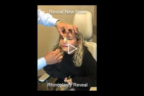 Emotional Rhinoplasty Reveal - See Patients Reaction Removing Cast After Nose Surgery
