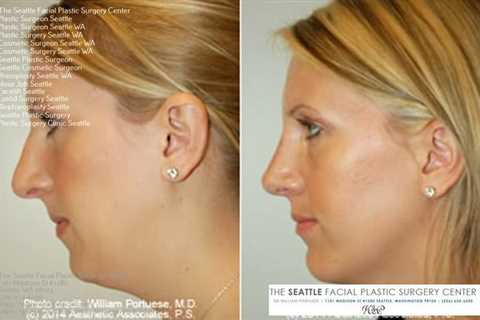 facelift seattle surgeon | Facial implant, Nose surgery, Nose surgeon