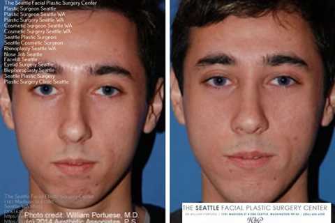 plastic surgery seattle | Rhinoplasty, Nose surgery, Plastic surgery