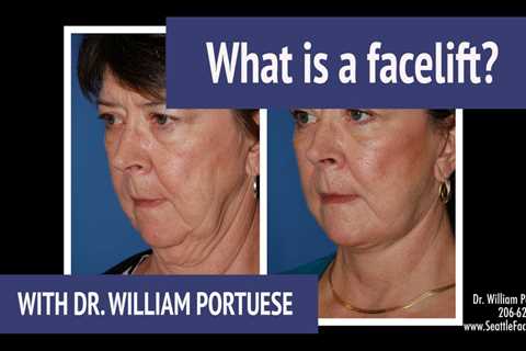 Face & Neck Lift with Before & After Photos by Dr. Portuese - Seattle - Portland - Ketchum