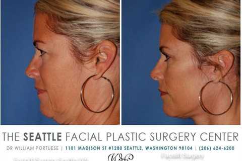 facelift surgery seattle | Face lift surgery, Facial plastic, Facial surgery