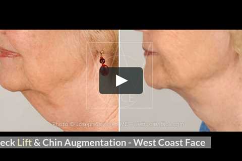 Neck Lift in Seattle Washington