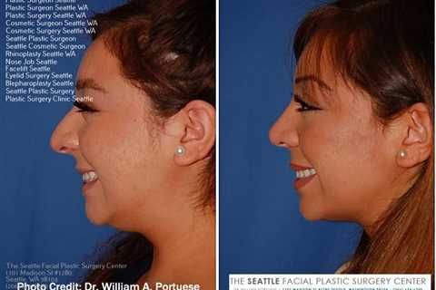 facial plastic surgeon seattle | Facial plastic, Nose job, Plastic surgeon