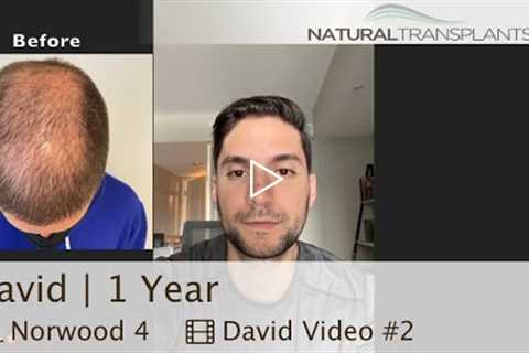 Hair Loss Treatment for Men | 1 Year Hair Transplant Results by Dr. Kevin Blumenthal (David)