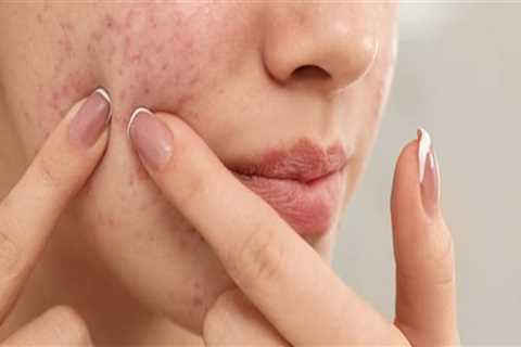 Which is best home remedy to clear the skin?