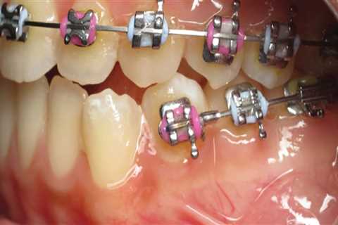 What is phase 3 orthodontic treatment?