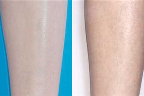 What happens if you don't shave before laser hair removal?