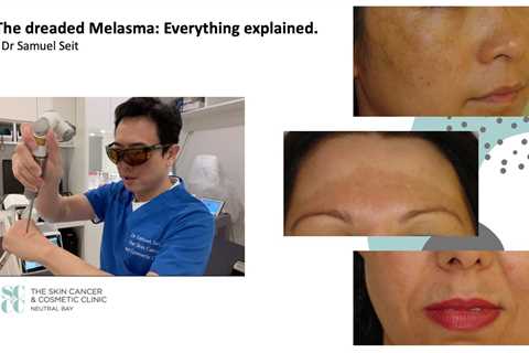 Melasma: Everything explained - Dr Samuel Seit  HD 720p