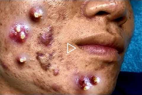 Cystic Acne Extraction Big Blackheads Removal Relaxing HD Quality #1