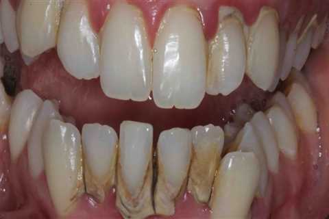 How long do gums hurt after veneers?
