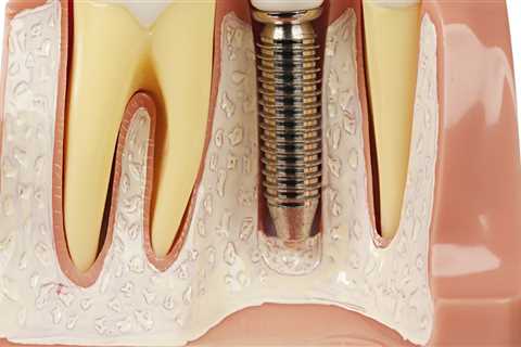 Can dental implants change face shape?