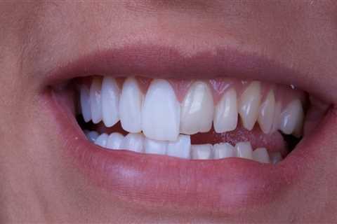 Why dental veneers?