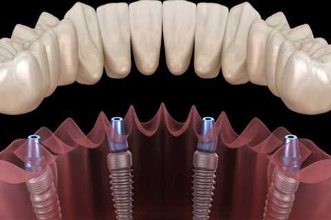 What is the best implant for teeth?