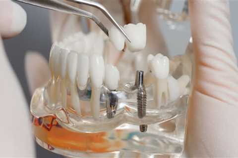 Will dental implants get cheaper?