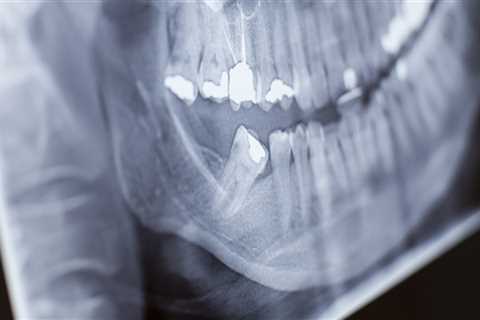 Why Are Dental X-Rays Necessary In Fairview Before Doing Any Dental Procedures