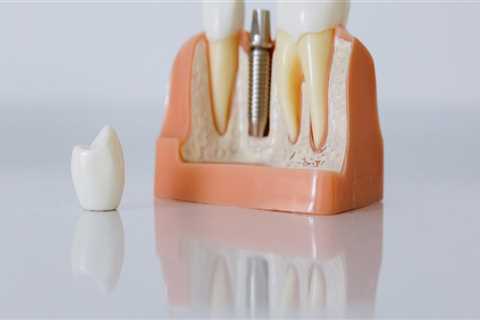 Dental Implants After Tooth Extraction In London: What You Should Know