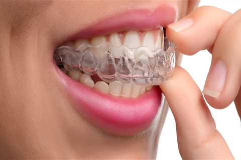 Can aligners bring down teeth?