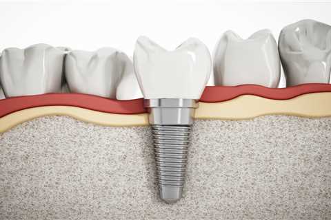 What Do All on Four Dental Implants Cost? - Reality Paper