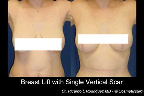 How Bad Are Breast Reduction Scars?