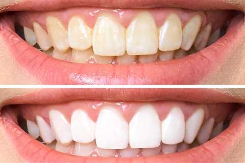 Yellow Teeth? Make 'Em Whiter in Minutes With These DIY Dental Hacks