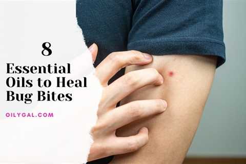Top 8 Essential Oils to Heal Bug Bites and Prevent Them Too!