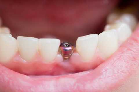 Top 4 Care Tips For Your Dental Implant | Arreh